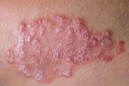 Living with Lupus: Natural Ways to Thrive Mediaage NG Something is deeply wrong with Tike, but no one seems to know what it is. She’s been to several hospitals, yet the situation remains a puzzle. Her mother, desperate for answers, returns from a mountain of prayer where the woli declared that Tike’s illness is the result of a spiritual attack from the village. Her husband is overwhelmed, torn between disbelief and fear.